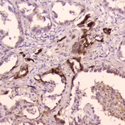 CTSE / Cathepsin E Antibody - IHC analysis of Cathepsin E using anti-Cathepsin E antibody. Cathepsin E was detected in paraffin-embedded section of human Lung cancer tissue. Heat mediated antigen retrieval was performed in citrate buffer (pH6, epitope retrieval solution) for 20 mins. The tissue section was blocked with 10% goat serum. The tissue section was then incubated with 2?g/ml rabbit anti-Cathepsin E Antibody overnight at 4?C. Biotinylated goat anti-rabbit IgG was used as secondary antibody and incubated for 30 minutes at 37?C. The tissue section was developed using Strepavidin-Biotin-Complex (SABC) with DAB as the chromogen.