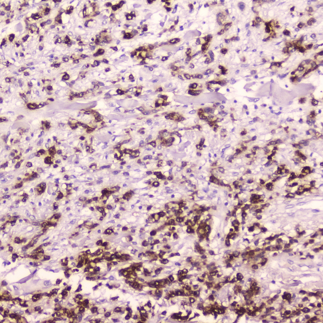 CTSE / Cathepsin E Antibody - IHC analysis of Cathepsin E using anti-Cathepsin E antibody. Cathepsin E was detected in paraffin-embedded section of human gastric cancer tissue. Heat mediated antigen retrieval was performed in citrate buffer (pH6, epitope retrieval solution) for 20 mins. The tissue section was blocked with 10% goat serum. The tissue section was then incubated with 2?g/ml rabbit anti-Cathepsin E Antibody overnight at 4?C. Biotinylated goat anti-rabbit IgG was used as secondary antibody and incubated for 30 minutes at 37?C. The tissue section was developed using Strepavidin-Biotin-Complex (SABC) with DAB as the chromogen.