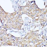 CTSF / Cathepsin F Antibody - Immunohistochemistry of paraffin-embedded Human breast cancer using CTSF Polyclonal Antibody at dilution of 1:100 (40x lens).