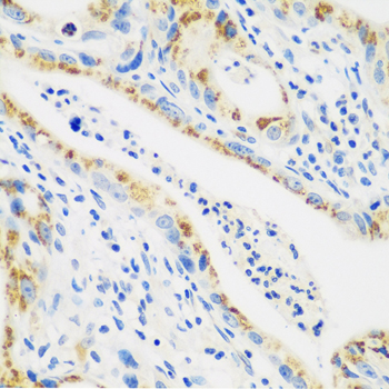 CTSG / Cathepsin G Antibody - Immunohistochemistry of paraffin-embedded human stomach cancer tissue.