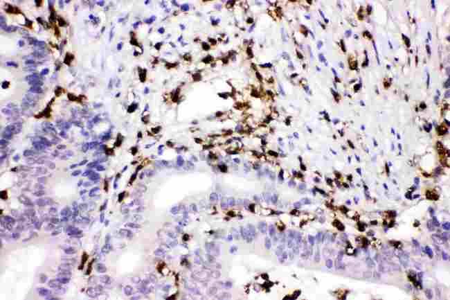 CTSG / Cathepsin G Antibody - Cathepsin G was detected in paraffin-embedded sections of human intestinal cancer tissues using rabbit anti- Cathepsin G Antigen Affinity purified polyclonal antibody