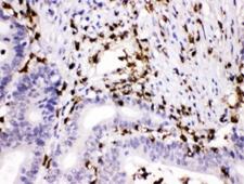 CTSG / Cathepsin G Antibody - IHC testing of FFPE human intestinal cancer with Cathepsin G antibody at 1ug/ml. HIER: steam section in pH6 citrate buffer for 20 min.