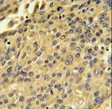 CTSH / Cathepsin H Antibody - CTSH Antibody IHC of formalin-fixed and paraffin-embedded human hepatocarcinoma followed by peroxidase-conjugated secondary antibody and DAB staining.