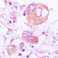 CTSH / Cathepsin H Antibody - Immunohistochemical analysis of Cathepsin H staining in human lung cancer formalin fixed paraffin embedded tissue section. The section was pre-treated using heat mediated antigen retrieval with sodium citrate buffer (pH 6.0). The section was then incubated with the antibody at room temperature and detected using an HRP conjugated compact polymer system. DAB was used as the chromogen. The section was then counterstained with hematoxylin and mounted with DPX.