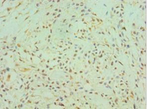CTSK / Cathepsin K Antibody - Immunohistochemistry of paraffin-embedded human breast cancer using antibody at 1:100 dilution.