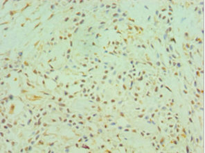 CTSK / Cathepsin K Antibody - Immunohistochemistry of paraffin-embedded human breast cancer using CTSK Antibody at dilution of 1:100