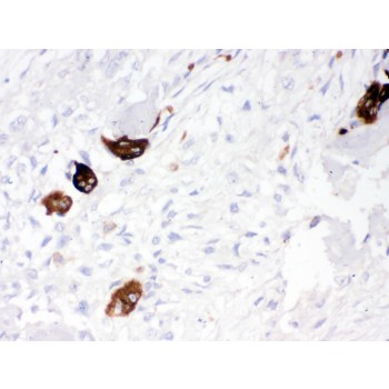 CTSK / Cathepsin K Antibody - Cathepsin K was detected in paraffin-embedded sections of human osteosarcoma tissues using rabbit anti- Cathepsin K Antigen Affinity purified polyclonal antibody at 1 ug/mL. The immunohistochemical section was developed using SABC method.