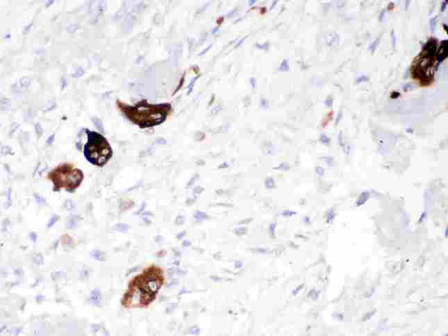 CTSK / Cathepsin K Antibody - Cathepsin K was detected in paraffin-embedded sections of human osteosarcoma tissues using rabbit anti-Cathepsin K Antigen Affinity purified polyclonal antibody at 1 µg/mL. The immunohistochemical section was developed using SABC method