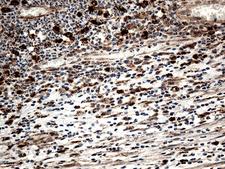 CTSL / Cathepsin L Antibody - Immunohistochemical staining of paraffin-embedded Human thyroid tissue within the normal limits using anti-CTSL mouse monoclonal antibody. (Heat-induced epitope retrieval by 1mM EDTA in 10mM Tris buffer. (pH8.5) at 120°C for 3 min. (1:500)