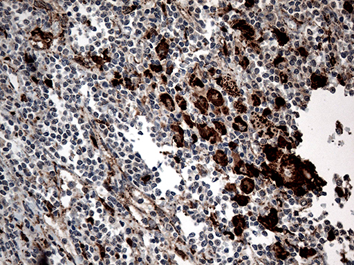 CTSL / Cathepsin L Antibody - Immunohistochemical staining of paraffin-embedded Human lymphoma tissue using anti-CTSL mouse monoclonal antibody. (Heat-induced epitope retrieval by 1mM EDTA in 10mM Tris buffer. (pH8.5) at 120°C for 3 min. (1:500)