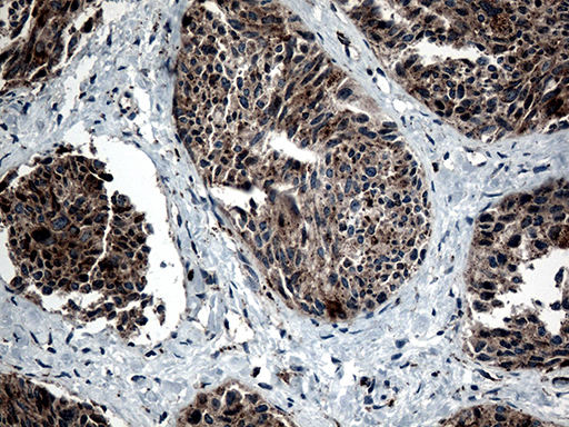 CTSL / Cathepsin L Antibody - Immunohistochemical staining of paraffin-embedded Carcinoma of Human thyroid tissue using anti-CTSL mouse monoclonal antibody. (Heat-induced epitope retrieval by 1mM EDTA in 10mM Tris buffer. (pH8.5) at 120°C for 3 min. (1:500)