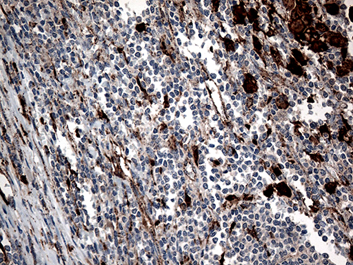 CTSL / Cathepsin L Antibody - Immunohistochemical staining of paraffin-embedded Human lymphoma tissue using anti-CTSL mouse monoclonal antibody. (Heat-induced epitope retrieval by 1mM EDTA in 10mM Tris buffer. (pH8.5) at 120°C for 3 min. (1:500)