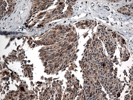 CTSL / Cathepsin L Antibody - Immunohistochemical staining of paraffin-embedded Carcinoma of Human thyroid tissue using anti-CTSL mouse monoclonal antibody. (Heat-induced epitope retrieval by 1mM EDTA in 10mM Tris buffer. (pH8.5) at 120°C for 3 min. (1:500)