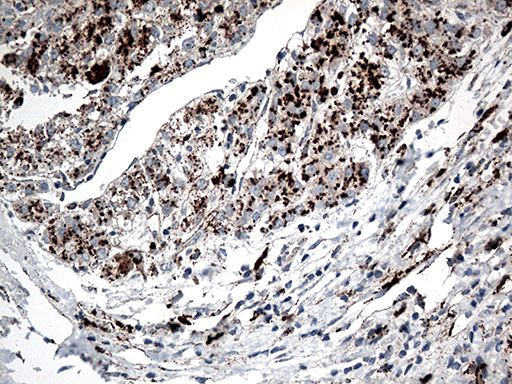 CTSL / Cathepsin L Antibody - Immunohistochemical staining of paraffin-embedded Carcinoma of Human liver tissue using anti-CTSL mouse monoclonal antibody. (Heat-induced epitope retrieval by 1mM EDTA in 10mM Tris buffer. (pH8.5) at 120°C for 3 min. (1:500)