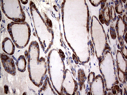 CTSL / Cathepsin L Antibody - Immunohistochemical staining of paraffin-embedded Human thyroid tissue within the normal limits using anti-CTSL mouse monoclonal antibody. (Heat-induced epitope retrieval by 1mM EDTA in 10mM Tris buffer. (pH8.5) at 120°C for 3 min. (1:2000)