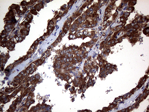 CTSL / Cathepsin L Antibody - Immunohistochemical staining of paraffin-embedded Carcinoma of Human thyroid tissue using anti-CTSL mouse monoclonal antibody. (Heat-induced epitope retrieval by 1mM EDTA in 10mM Tris buffer. (pH8.5) at 120°C for 3 min. (1:2000)