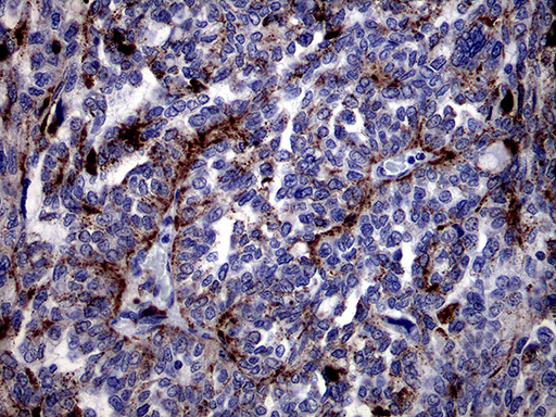 CTSL / Cathepsin L Antibody - Immunohistochemical staining of paraffin-embedded Adenocarcinoma of Human ovary tissue using anti-CTSL1 mouse monoclonal antibody. (Heat-induced epitope retrieval by 1mM EDTA in 10mM Tris buffer. (pH8.5) at 120°C for 3 min. (1:2000)