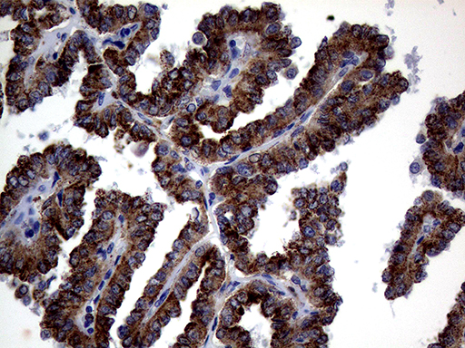 CTSL / Cathepsin L Antibody - Immunohistochemical staining of paraffin-embedded Carcinoma of Human thyroid tissue using anti-CTSL1 mouse monoclonal antibody. (Heat-induced epitope retrieval by 1mM EDTA in 10mM Tris buffer. (pH8.5) at 120°C for 3 min. (1:2000)