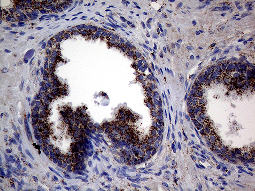 CTSL / Cathepsin L Antibody - Immunohistochemical staining of paraffin-embedded Carcinoma of Human prostate tissue using anti-CTSL1 mouse monoclonal antibody. (Heat-induced epitope retrieval by 1mM EDTA in 10mM Tris buffer. (pH8.5) at 120°C for 3 min. (1:2000)