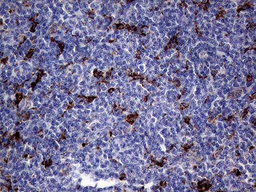 CTSL / Cathepsin L Antibody - Immunohistochemical staining of paraffin-embedded Human lymphoma tissue using anti-CTSL1 mouse monoclonal antibody. (Heat-induced epitope retrieval by 1mM EDTA in 10mM Tris buffer. (pH8.5) at 120°C for 3 min. (1:2000)