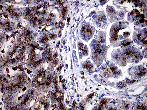 CTSL / Cathepsin L Antibody - Immunohistochemical staining of paraffin-embedded Carcinoma of Human liver tissue using anti-CTSL1 mouse monoclonal antibody. (Heat-induced epitope retrieval by 1mM EDTA in 10mM Tris buffer. (pH8.5) at 120°C for 3 min. (1:2000)