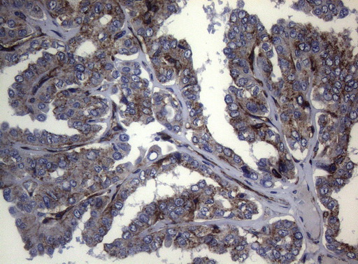 CTSL / Cathepsin L Antibody - Immunohistochemical staining of paraffin-embedded Carcinoma of Human thyroid tissue using anti-CTSL1 mouse monoclonal antibody. (Heat-induced epitope retrieval by 1mM EDTA in 10mM Tris buffer. (pH8.5) at 120°C for 3 min. (1:150)