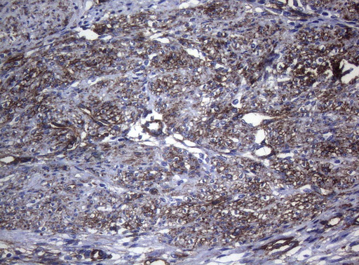CTSL / Cathepsin L Antibody - Immunohistochemical staining of paraffin-embedded Human endometrium tissue within the normal limits using anti-CTSL1 mouse monoclonal antibody. (Heat-induced epitope retrieval by 1mM EDTA in 10mM Tris buffer. (pH8.5) at 120°C for 3 min. (1:150)