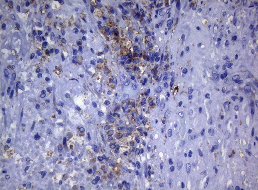 CTSL / Cathepsin L Antibody - Immunohistochemical staining of paraffin-embedded Carcinoma of Human bladder tissue using anti-CTSL1 mouse monoclonal antibody. (Heat-induced epitope retrieval by 1mM EDTA in 10mM Tris buffer. (pH8.5) at 120°C for 3 min. (1:150)