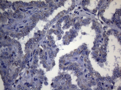 CTSL / Cathepsin L Antibody - Immunohistochemical staining of paraffin-embedded Carcinoma of Human thyroid tissue using anti-CTSL1 mouse monoclonal antibody. (Heat-induced epitope retrieval by 1mM EDTA in 10mM Tris buffer. (pH8.5) at 120°C for 3 min. (1:150)