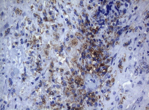 CTSL / Cathepsin L Antibody - Immunohistochemical staining of paraffin-embedded Carcinoma of Human bladder tissue using anti-CTSL1 mouse monoclonal antibody. (Heat-induced epitope retrieval by 1mM EDTA in 10mM Tris buffer. (pH8.5) at 120°C for 3 min. (1:150)