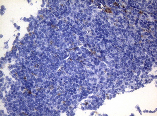 CTSL / Cathepsin L Antibody - Immunohistochemical staining of paraffin-embedded Human lymphoma tissue using anti-CTSL1 mouse monoclonal antibody. (Heat-induced epitope retrieval by 1mM EDTA in 10mM Tris buffer. (pH8.5) at 120°C for 3 min. (1:150)