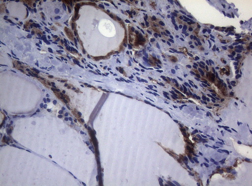 CTSL / Cathepsin L Antibody - Immunohistochemical staining of paraffin-embedded Human thyroid tissue within the normal limits using anti-CTSL1 mouse monoclonal antibody. (Heat-induced epitope retrieval by 1mM EDTA in 10mM Tris buffer. (pH8.5) at 120°C for 3 min. (1:150)