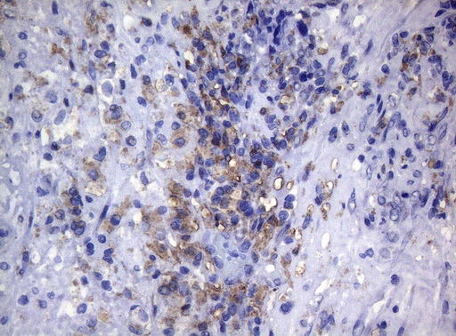 CTSL / Cathepsin L Antibody - Immunohistochemical staining of paraffin-embedded Carcinoma of Human bladder tissue using anti-CTSL1 mouse monoclonal antibody. (Heat-induced epitope retrieval by 1mM EDTA in 10mM Tris buffer. (pH8.5) at 120°C for 3 min. (1:150)