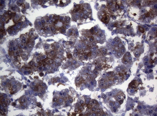 CTSL / Cathepsin L Antibody - Immunohistochemical staining of paraffin-embedded Carcinoma of Human liver tissue using anti-CTSL1 mouse monoclonal antibody. (Heat-induced epitope retrieval by 1mM EDTA in 10mM Tris buffer. (pH8.5) at 120°C for 3 min. (1:150)