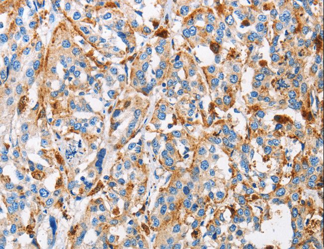 CTSL / Cathepsin L Antibody - Immunohistochemistry of paraffin-embedded Human thyroid cancer using CTSL Polyclonal Antibody at dilution of 1:50.