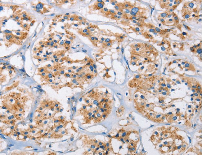 CTSL / Cathepsin L Antibody - Immunohistochemistry of paraffin-embedded Human thyroid cancer using CTSL Polyclonal Antibody at dilution of 1:40.