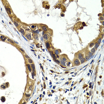 CTSS / Cathepsin S Antibody - Immunohistochemistry of paraffin-embedded human stomach cancer tissue.
