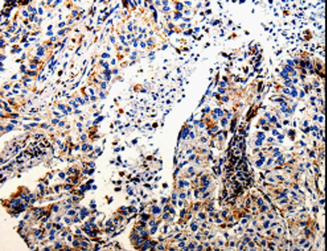 CTSZ / Cathepsin Z Antibody - Immunohistochemistry of paraffin-embedded Human lung cancer using CTSZ Polyclonal Antibody at dilution of 1:25.