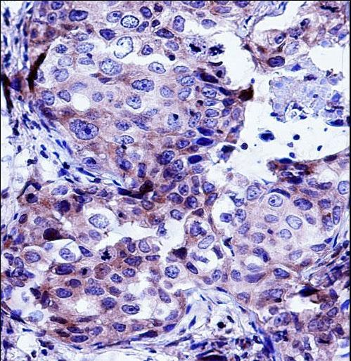 CTTN / Cortactin Antibody - CTTN Antibody immunohistochemistry of formalin-fixed and paraffin-embedded human breast carcinoma followed by peroxidase-conjugated secondary antibody and DAB staining.