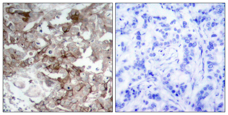 CTTN / Cortactin Antibody - Immunohistochemistry analysis of paraffin-embedded human breast carcinoma tissue, using Cortactin Antibody. The picture on the right is blocked with the synthesized peptide.
