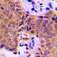 CTTN / Cortactin Antibody - Immunohistochemical analysis of Cortactin staining in human breast cancer formalin fixed paraffin embedded tissue section. The section was pre-treated using heat mediated antigen retrieval with sodium citrate buffer (pH 6.0). The section was then incubated with the antibody at room temperature and detected using an HRP conjugated compact polymer system. DAB was used as the chromogen. The section was then counterstained with hematoxylin and mounted with DPX.