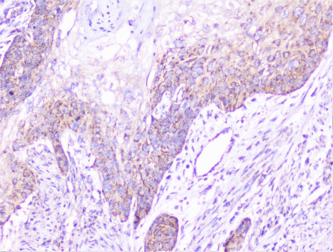 CTTN / Cortactin Antibody - IHC analysis of cortactin using anti-cortactin antibody. cortactin was detected in paraffin-embedded section of human oesophagus squama cancer tissue. Heat mediated antigen retrieval was performed in citrate buffer (pH6, epitope retrieval solution) for 20 mins. The tissue section was blocked with 10% goat serum. The tissue section was then incubated with 1µg/ml rabbit anti-cortactin Antibody overnight at 4°C. Biotinylated goat anti-rabbit IgG was used as secondary antibody and incubated for 30 minutes at 37°C. The tissue section was developed using Strepavidin-Biotin-Complex (SABC) with DAB as the chromogen.