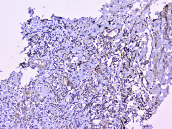 CTTN / Cortactin Antibody - IHC analysis of cortactin using anti-cortactin antibody. cortactin was detected in paraffin-embedded section of human rectal cancer tissue. Heat mediated antigen retrieval was performed in citrate buffer (pH6, epitope retrieval solution) for 20 mins. The tissue section was blocked with 10% goat serum. The tissue section was then incubated with 1µg/ml rabbit anti-cortactin Antibody overnight at 4°C. Biotinylated goat anti-rabbit IgG was used as secondary antibody and incubated for 30 minutes at 37°C. The tissue section was developed using Strepavidin-Biotin-Complex (SABC) with DAB as the chromogen.