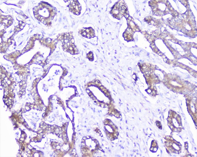 CTTN / Cortactin Antibody - IHC analysis of cortactin using anti-cortactin antibody. cortactin was detected in paraffin-embedded section of human cholangiocarcinoma tissue. Heat mediated antigen retrieval was performed in citrate buffer (pH6, epitope retrieval solution) for 20 mins. The tissue section was blocked with 10% goat serum. The tissue section was then incubated with 1µg/ml rabbit anti-cortactin Antibody overnight at 4°C. Biotinylated goat anti-rabbit IgG was used as secondary antibody and incubated for 30 minutes at 37°C. The tissue section was developed using Strepavidin-Biotin-Complex (SABC) with DAB as the chromogen.