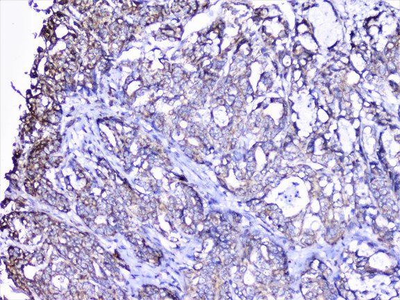 CTTN / Cortactin Antibody - IHC analysis of cortactin using anti-cortactin antibody. cortactin was detected in paraffin-embedded section of human gastric cancer tissue. Heat mediated antigen retrieval was performed in citrate buffer (pH6, epitope retrieval solution) for 20 mins. The tissue section was blocked with 10% goat serum. The tissue section was then incubated with 1µg/ml rabbit anti-cortactin Antibody overnight at 4°C. Biotinylated goat anti-rabbit IgG was used as secondary antibody and incubated for 30 minutes at 37°C. The tissue section was developed using Strepavidin-Biotin-Complex (SABC) with DAB as the chromogen.