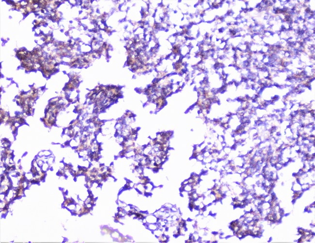 CTTN / Cortactin Antibody - IHC analysis of cortactin using anti-cortactin antibody. cortactin was detected in paraffin-embedded section of human glioma tissue. Heat mediated antigen retrieval was performed in citrate buffer (pH6, epitope retrieval solution) for 20 mins. The tissue section was blocked with 10% goat serum. The tissue section was then incubated with 1µg/ml rabbit anti-cortactin Antibody overnight at 4°C. Biotinylated goat anti-rabbit IgG was used as secondary antibody and incubated for 30 minutes at 37°C. The tissue section was developed using Strepavidin-Biotin-Complex (SABC) with DAB as the chromogen.