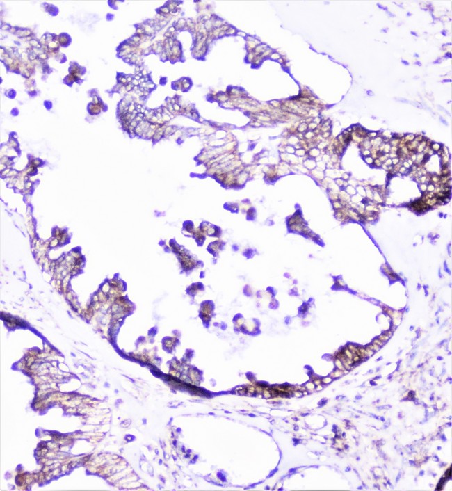 CTTN / Cortactin Antibody - IHC analysis of cortactin using anti-cortactin antibody. cortactin was detected in paraffin-embedded section of human ovary cancer tissue. Heat mediated antigen retrieval was performed in citrate buffer (pH6, epitope retrieval solution) for 20 mins. The tissue section was blocked with 10% goat serum. The tissue section was then incubated with 1µg/ml rabbit anti-cortactin Antibody overnight at 4°C. Biotinylated goat anti-rabbit IgG was used as secondary antibody and incubated for 30 minutes at 37°C. The tissue section was developed using Strepavidin-Biotin-Complex (SABC) with DAB as the chromogen.