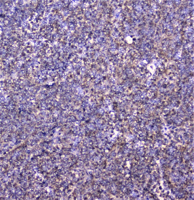 CTTN / Cortactin Antibody - IHC analysis of cortactin using anti-cortactin antibody. cortactin was detected in paraffin-embedded section of human sarcoma tissue. Heat mediated antigen retrieval was performed in citrate buffer (pH6, epitope retrieval solution) for 20 mins. The tissue section was blocked with 10% goat serum. The tissue section was then incubated with 1µg/ml rabbit anti-cortactin Antibody overnight at 4°C. Biotinylated goat anti-rabbit IgG was used as secondary antibody and incubated for 30 minutes at 37°C. The tissue section was developed using Strepavidin-Biotin-Complex (SABC) with DAB as the chromogen.