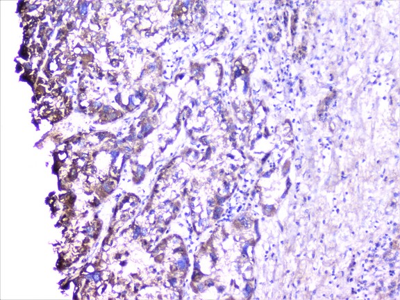 CTTN / Cortactin Antibody - IHC analysis of cortactin using anti-cortactin antibody. cortactin was detected in paraffin-embedded section of human liver cancer tissue. Heat mediated antigen retrieval was performed in citrate buffer (pH6, epitope retrieval solution) for 20 mins. The tissue section was blocked with 10% goat serum. The tissue section was then incubated with 1µg/ml rabbit anti-cortactin Antibody overnight at 4°C. Biotinylated goat anti-rabbit IgG was used as secondary antibody and incubated for 30 minutes at 37°C. The tissue section was developed using Strepavidin-Biotin-Complex (SABC) with DAB as the chromogen.