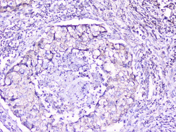 CTTN / Cortactin Antibody - IHC analysis of cortactin using anti-cortactin antibody. cortactin was detected in paraffin-embedded section of human lung cancer tissue. Heat mediated antigen retrieval was performed in citrate buffer (pH6, epitope retrieval solution) for 20 mins. The tissue section was blocked with 10% goat serum. The tissue section was then incubated with 1µg/ml rabbit anti-cortactin Antibody overnight at 4°C. Biotinylated goat anti-rabbit IgG was used as secondary antibody and incubated for 30 minutes at 37°C. The tissue section was developed using Strepavidin-Biotin-Complex (SABC) with DAB as the chromogen.